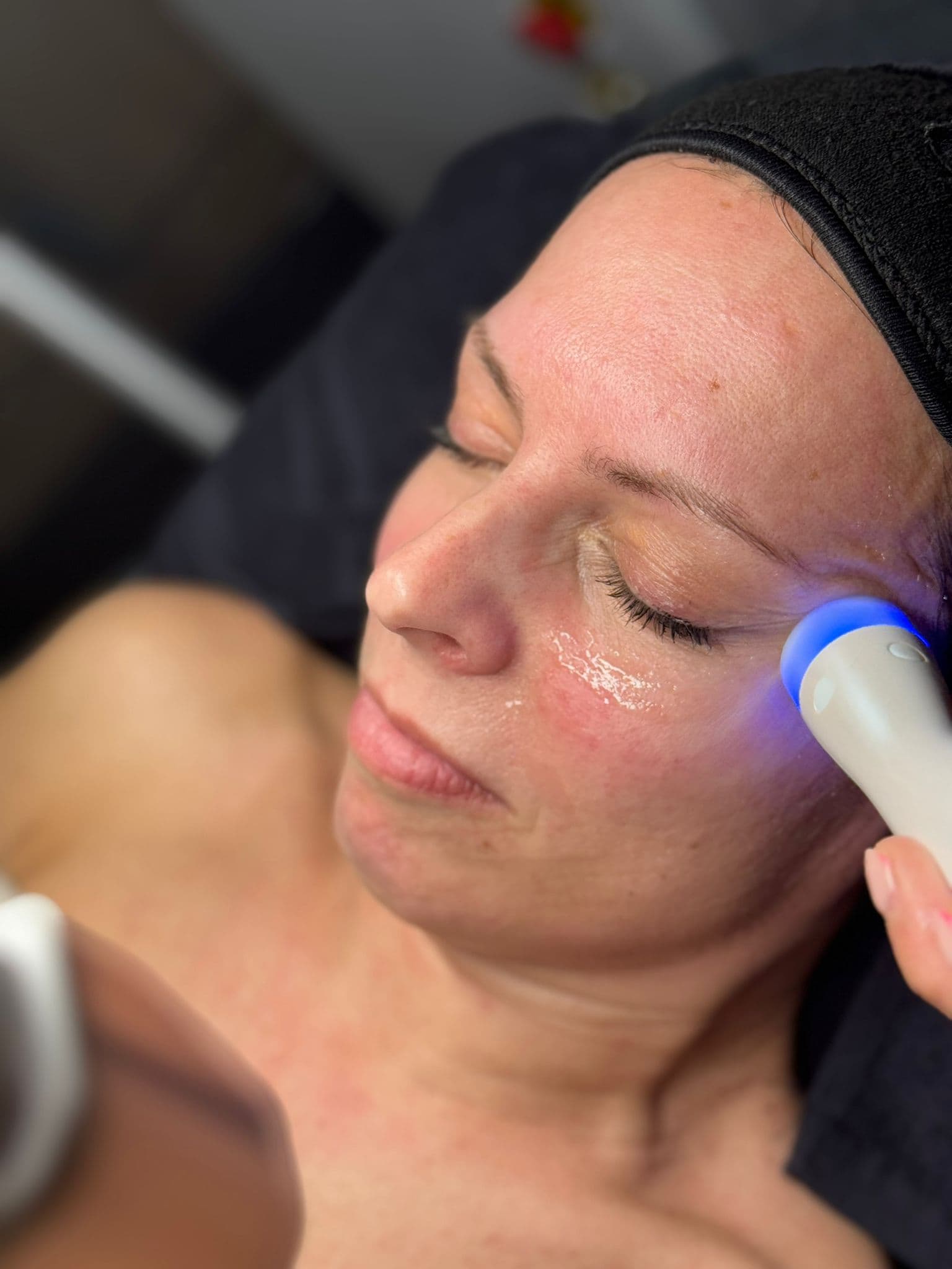 RF Skin Tightening at Olive Beauty