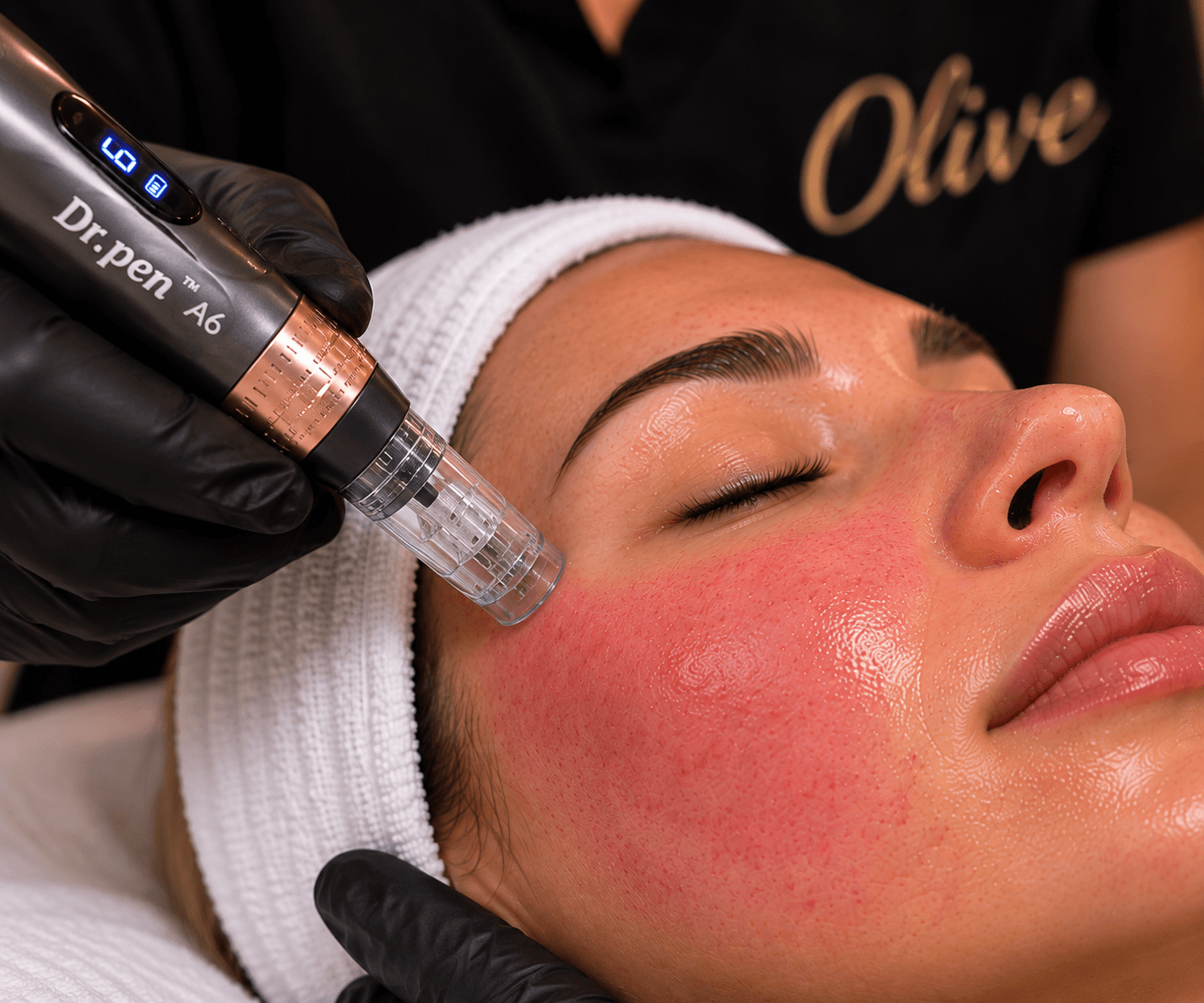 Microneedling at Olive Beauty