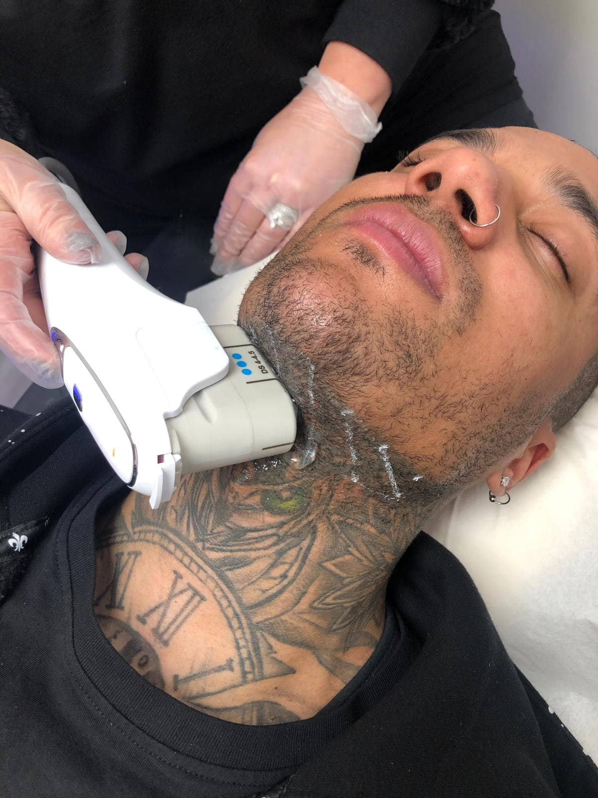 HIFU treatment
