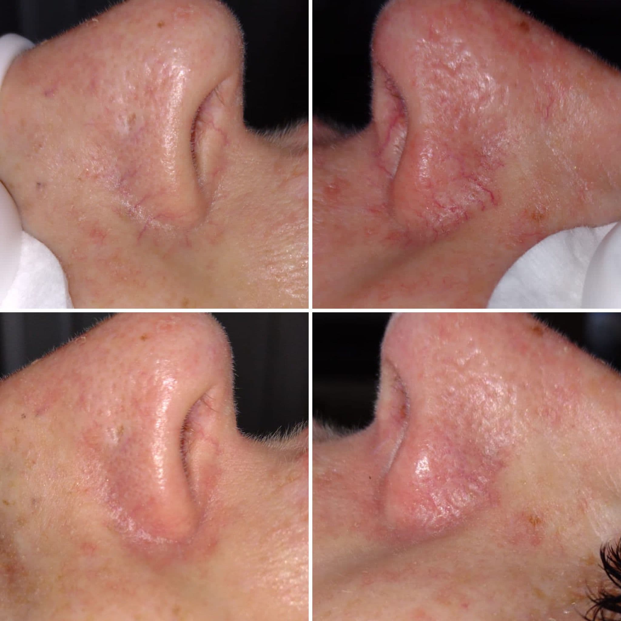 Thread Vein Removal treatment