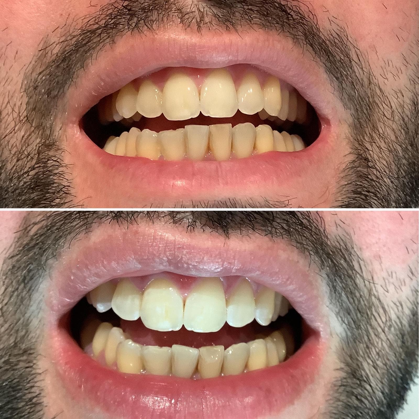 Laser Teeth Whitening treatment
