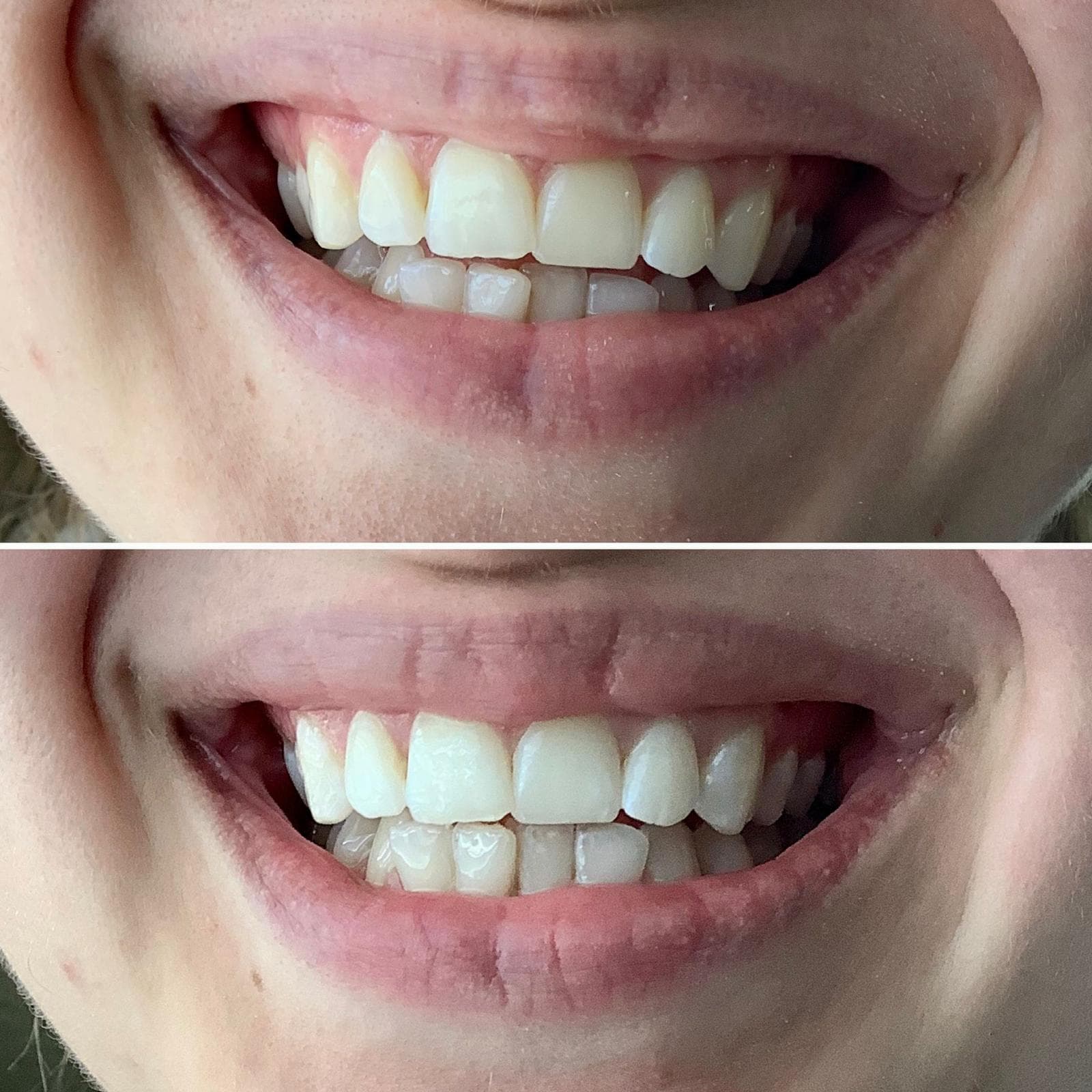 Laser Teeth Whitening at Olive Beauty & Aesthetics